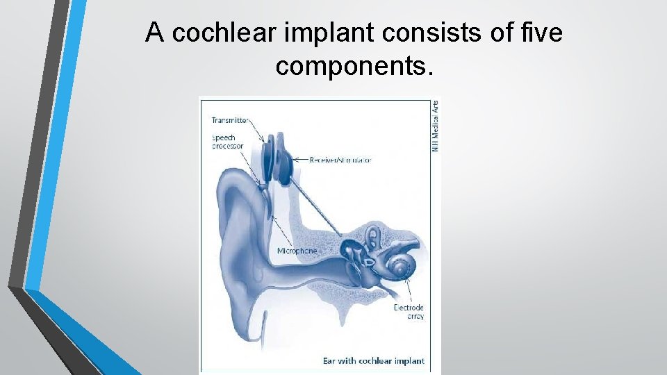 A cochlear implant consists of five components. 