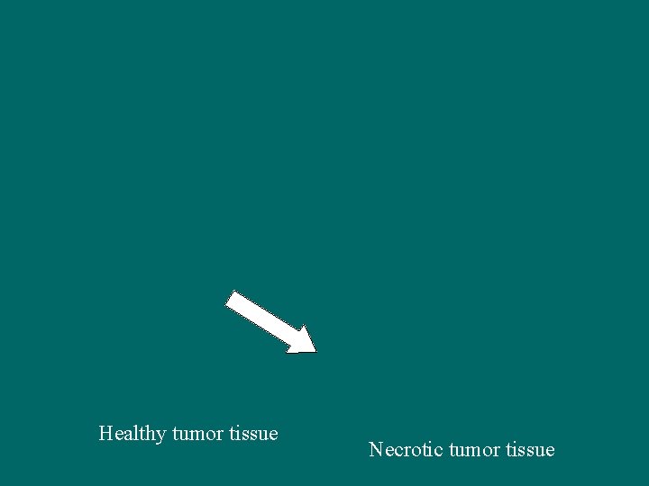 Healthy tumor tissue Necrotic tumor tissue 