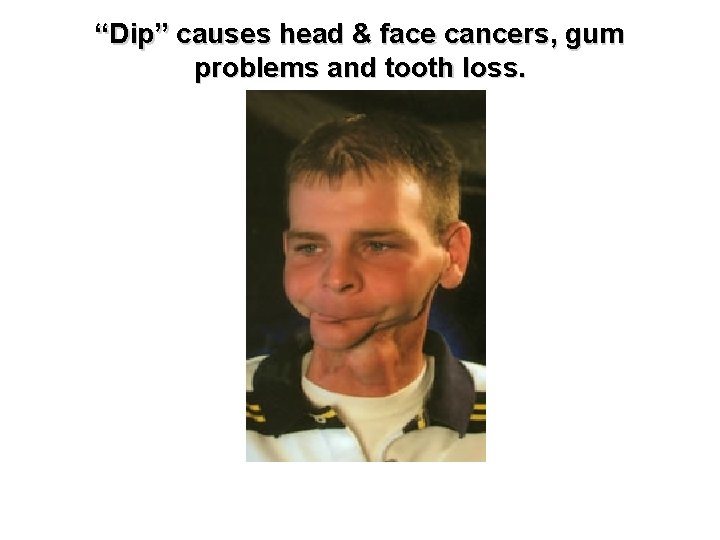 “Dip” causes head & face cancers, gum problems and tooth loss. 