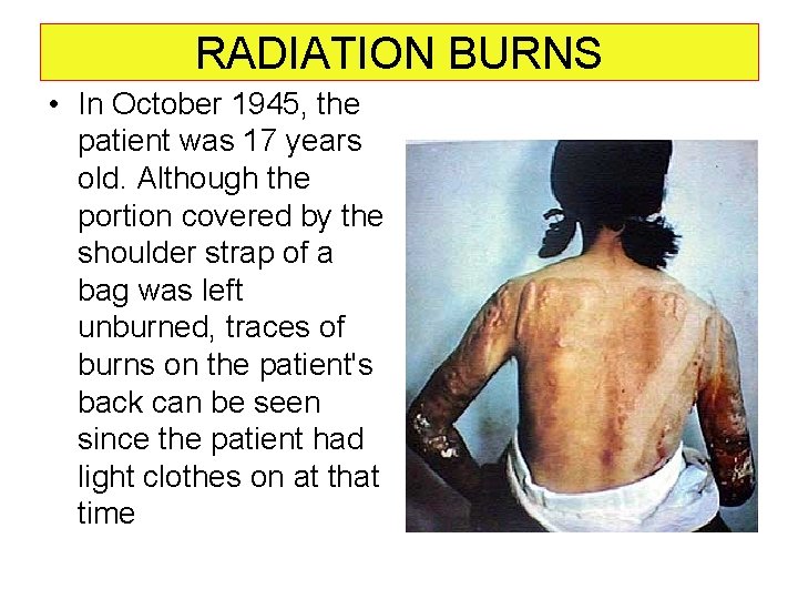 RADIATION BURNS • In October 1945, the patient was 17 years old. Although the