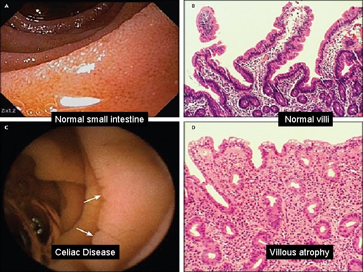 Normal small intestine Celiac Disease Normal villi Villous atrophy 