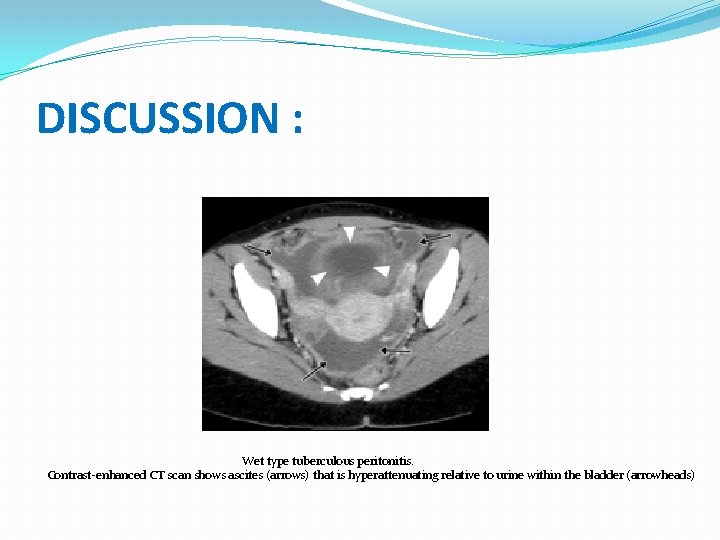 DISCUSSION : Wet type tuberculous peritonitis. Contrast-enhanced CT scan shows ascites (arrows) that is