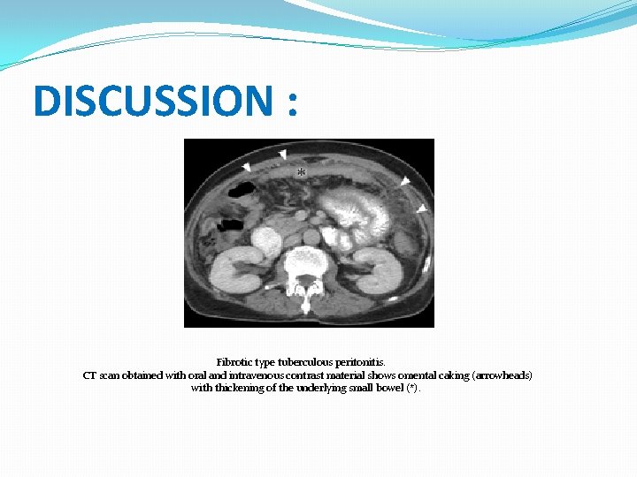DISCUSSION : Fibrotic type tuberculous peritonitis. CT scan obtained with oral and intravenous contrast