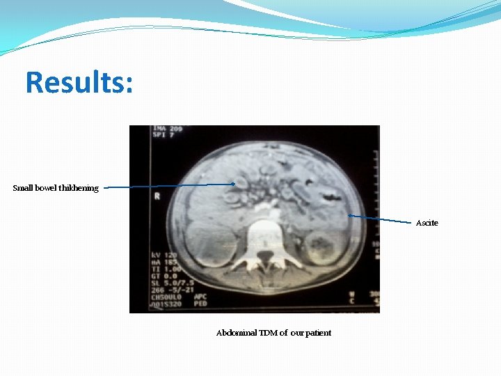 Results: Small bowel thikhening Ascite Abdominal TDM of our patient 