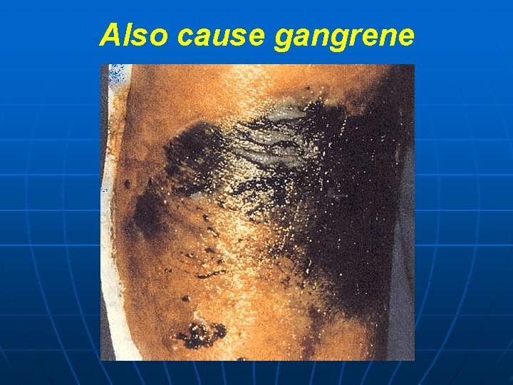 Also cause gangrene 