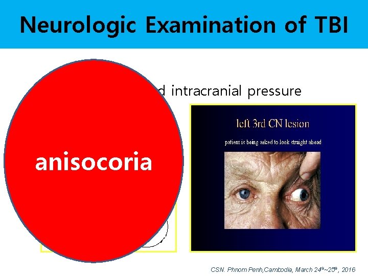 Neurologic Examination of TBI • Signs of increased intracranial pressure – Visual difficulties –