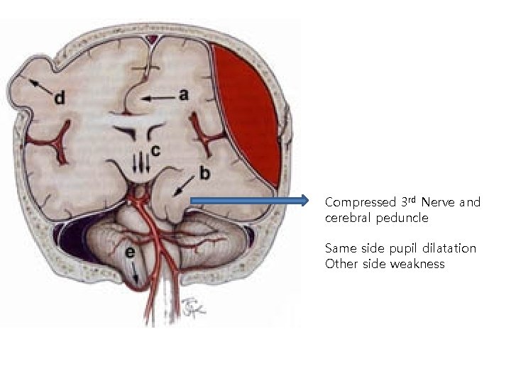 Compressed 3 rd Nerve and cerebral peduncle Same side pupil dilatation Other side weakness