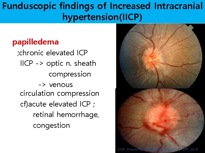 Funduscopic findings of Increased Intracranial hypertension(IICP) papilledema ; chronic elevated ICP IICP -> optic