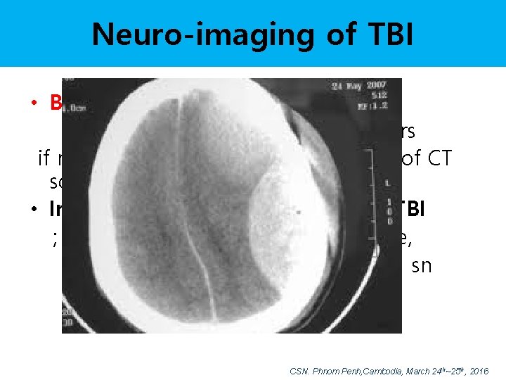 Neuro-imaging of TBI • Brain CT – first choice of TBI must be available