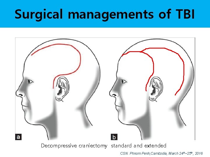 Surgical managements of TBI Decompressive craniectomy standard and extended CSN. Phnom Penh, Cambodia, March