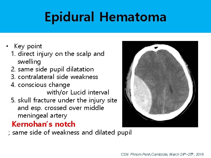 Epidural Hematoma • Key point 1. direct injury on the scalp and swelling 2.