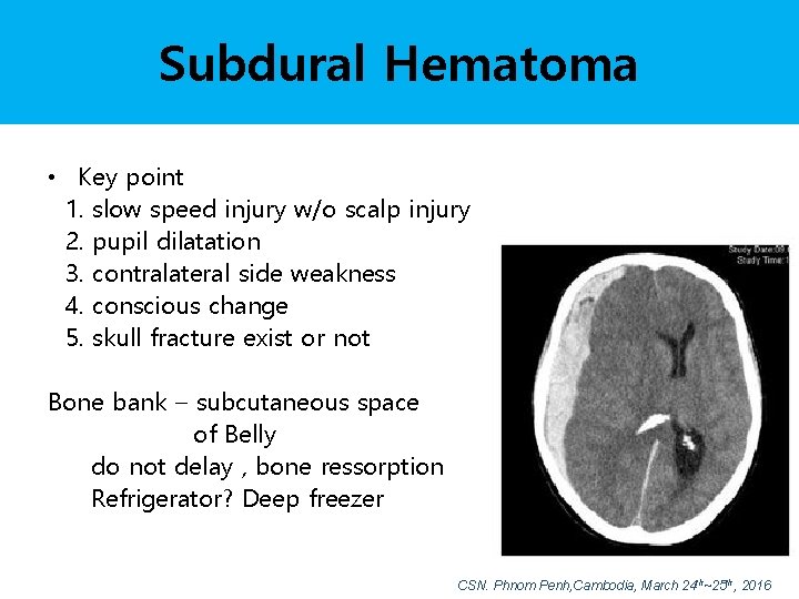 Subdural Hematoma • Key point 1. slow speed injury w/o scalp injury 2. pupil