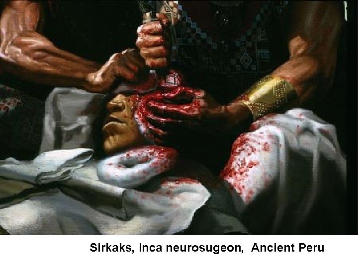 Sirkaks, Inca neurosugeon, Ancient Peru 