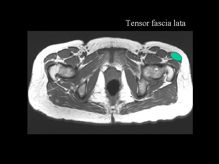 Tensor fascia lata 