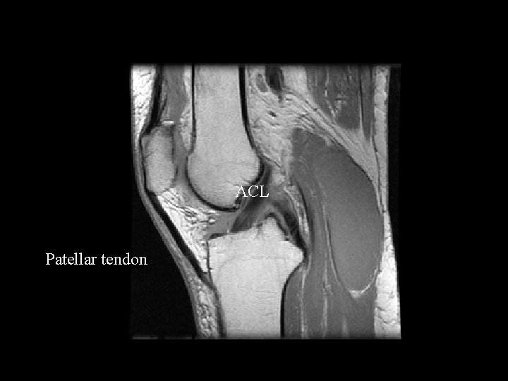 ACL Patellar tendon 