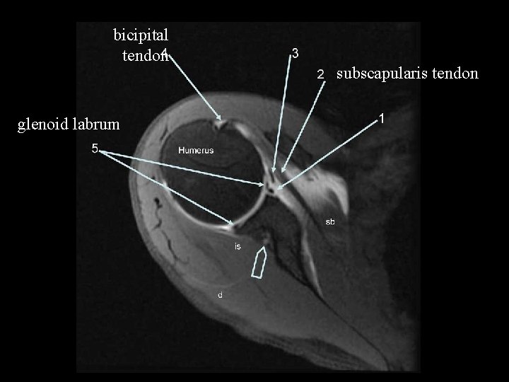bicipital tendon glenoid labrum subscapularis tendon 