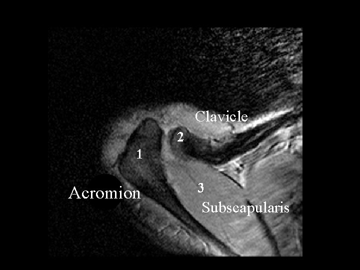 Clavicle Acromion Subscapularis 