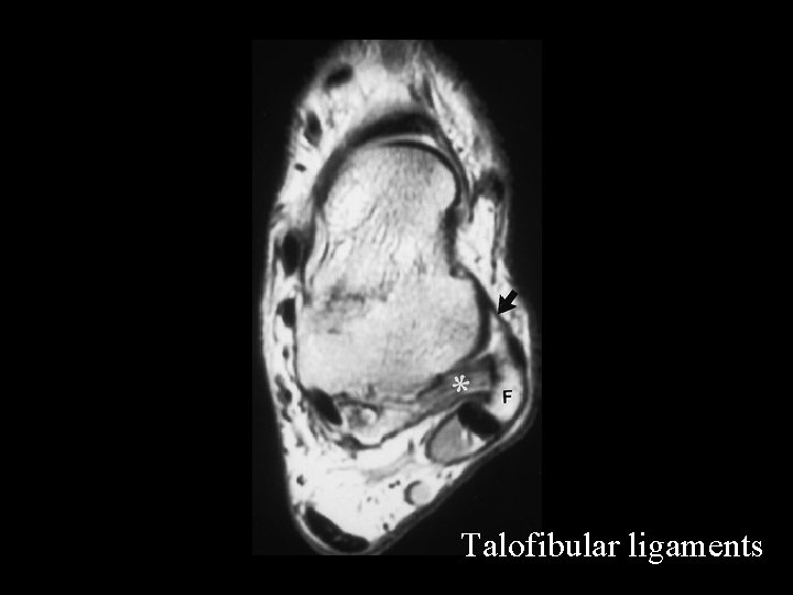 Talofibular ligaments 