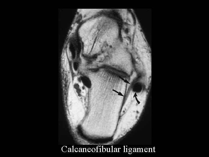 Calcaneofibular ligament 