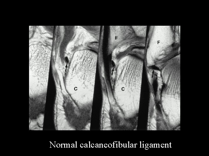 No Caption Found Rosenberg, Z. S. et al. Radiographics 2000; 20: S 153 -S