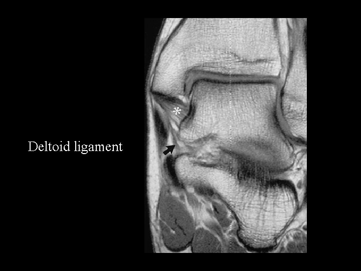 Deltoid ligament 