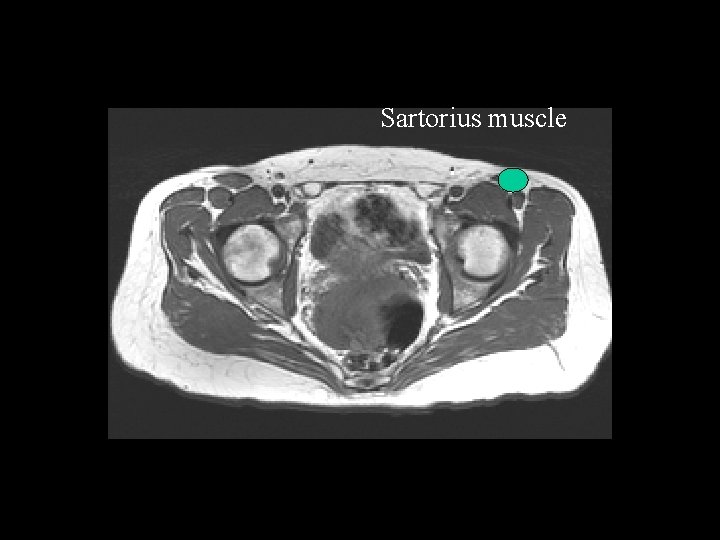 Sartorius muscle 