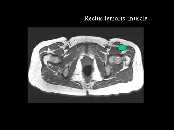 Rectus femoris muscle 