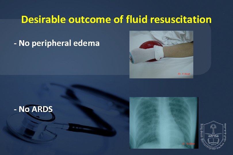 Desirable outcome of fluid resuscitation - No peripheral edema - No ARDS 