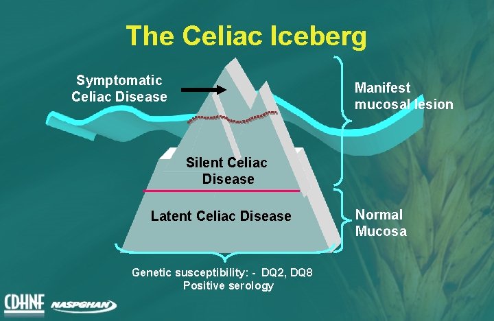 The Celiac Iceberg Symptomatic Celiac Disease Manifest mucosal lesion Silent Celiac Disease Latent Celiac