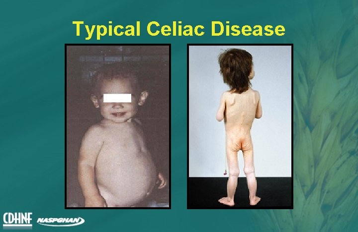 Typical Celiac Disease 