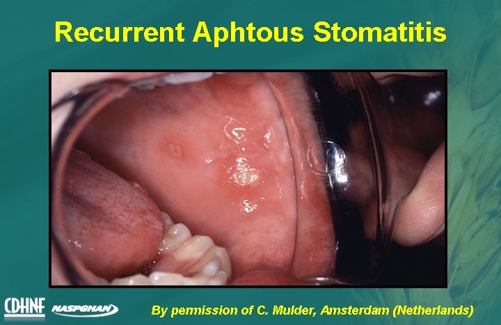 Recurrent Aphtous Stomatitis By permission of C. Mulder, Amsterdam (Netherlands) 