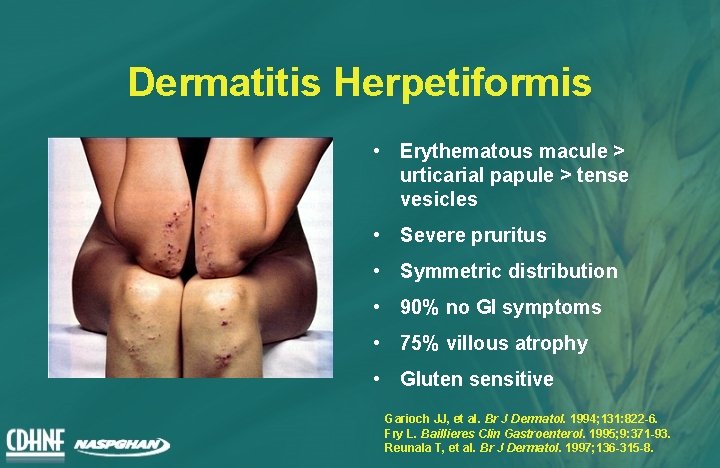 Dermatitis Herpetiformis • Erythematous macule > urticarial papule > tense vesicles • Severe pruritus