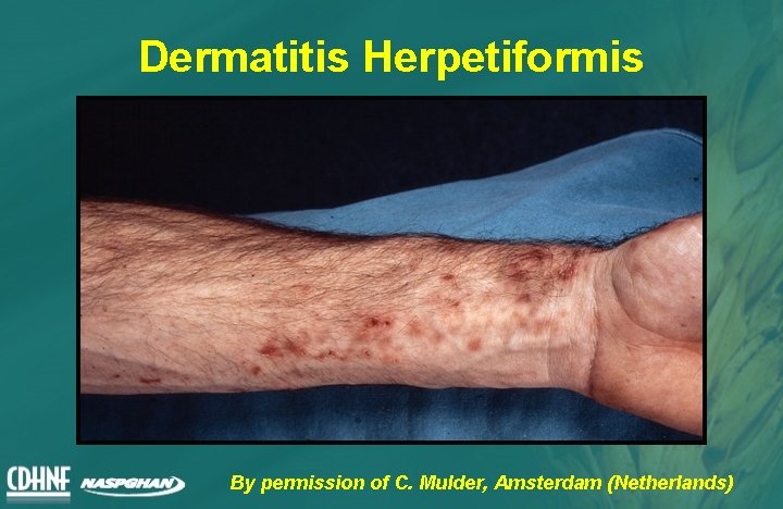 Dermatitis Herpetiformis By permission of C. Mulder, Amsterdam (Netherlands) 