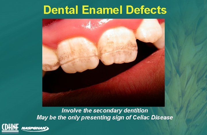 Dental Enamel Defects Involve the secondary dentition May be the only presenting sign of