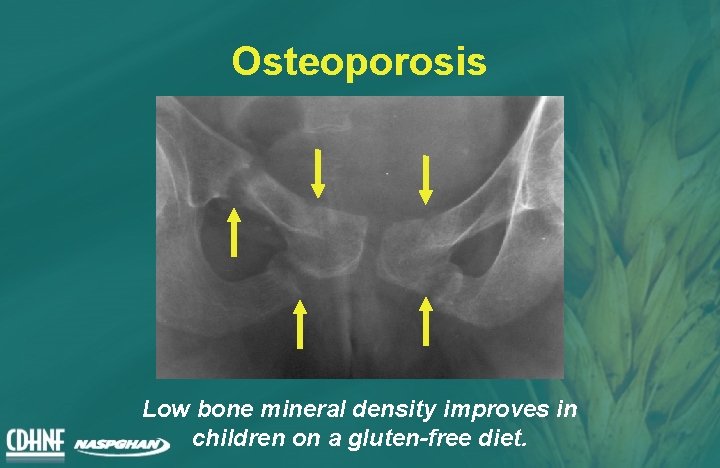 Osteoporosis Low bone mineral density improves in children on a gluten-free diet. 