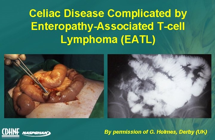 Celiac Disease Complicated by Enteropathy-Associated T-cell Lymphoma (EATL) By permission of G. Holmes, Derby