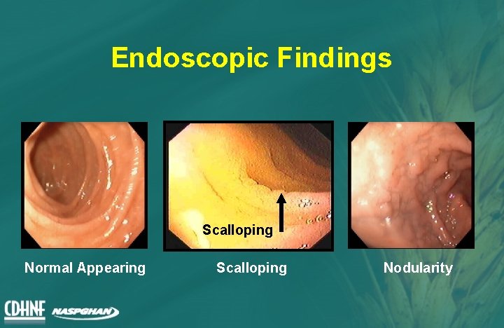 Endoscopic Findings Scalloping Normal Appearing Scalloping Nodularity 