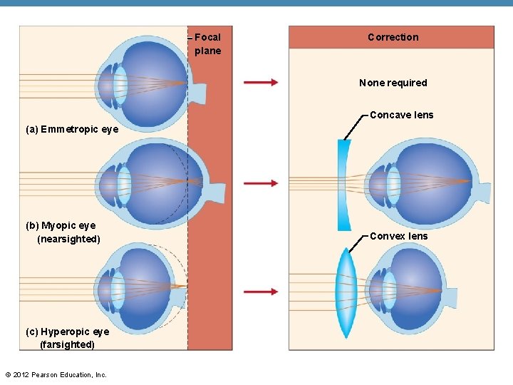 Focal plane Correction None required Concave lens (a) Emmetropic eye (b) Myopic eye (nearsighted)