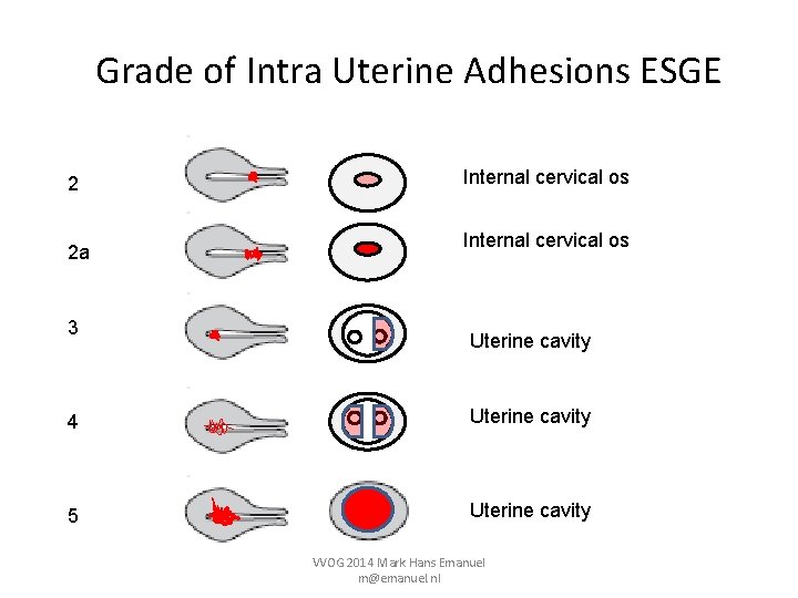 Grade of Intra Uterine Adhesions ESGE 2 2 a 3 Internal cervical os Uterine