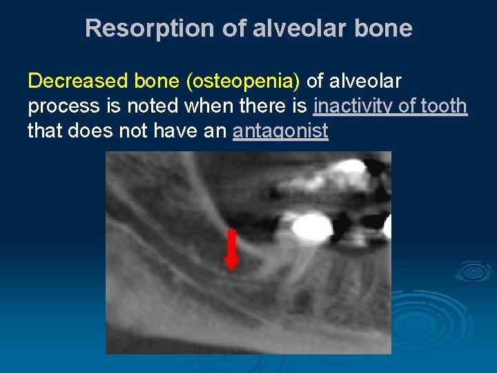 Resorption of alveolar bone Decreased bone (osteopenia) of alveolar process is noted when there