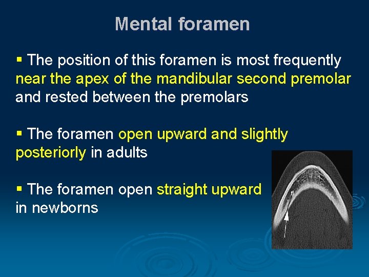 Mental foramen § The position of this foramen is most frequently near the apex