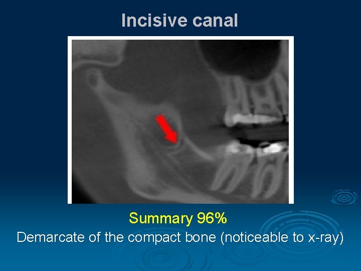 Incisive canal Summary 96% Demarcate of the compact bone (noticeable to x-ray) 