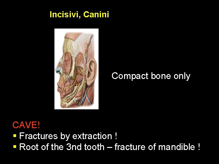 Incisivi, Canini Compact bone only CAVE! § Fractures by extraction ! § Root of
