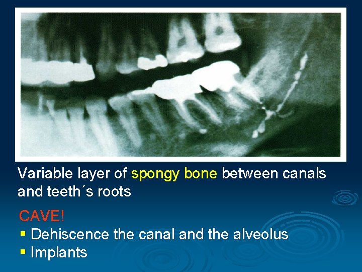 Variable layer of spongy bone between canals and teeth´s roots CAVE! § Dehiscence the