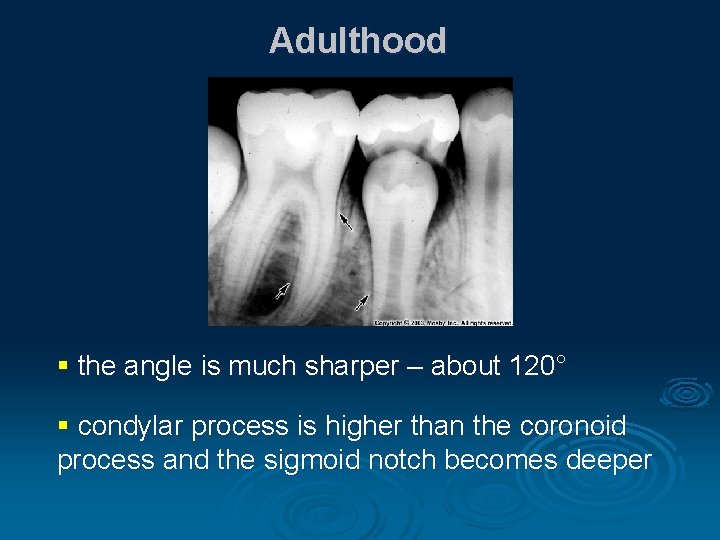 Adulthood § the angle is much sharper – about 120° § condylar process is