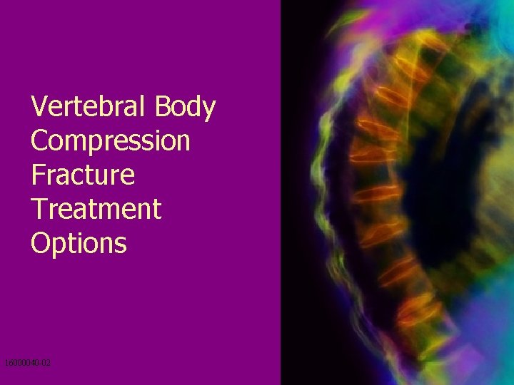 Vertebral Body Compression Fracture Treatment Options 16000040 -02 