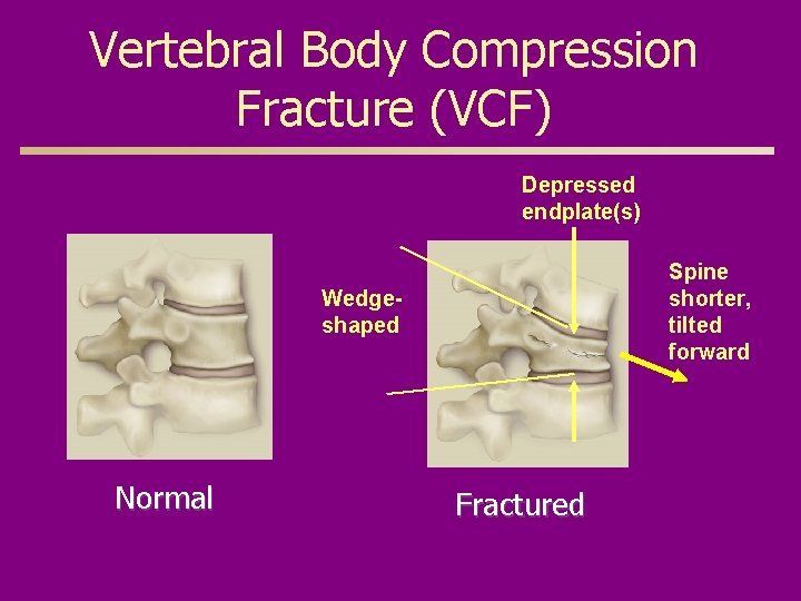Vertebral Body Compression Fracture (VCF) Depressed endplate(s) Spine shorter, tilted forward Wedgeshaped Normal Fractured