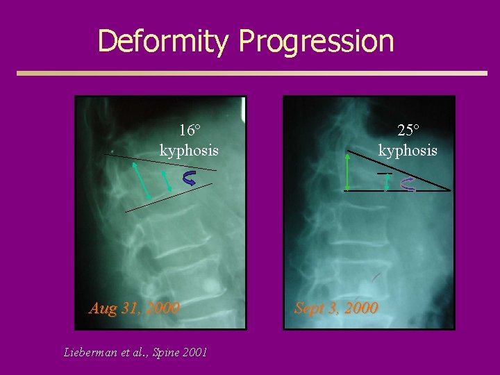 Deformity Progression 16º kyphosis Aug 31, 2000 Lieberman et al. , Spine 2001 25º