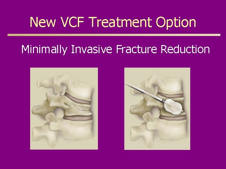 New VCF Treatment Option Minimally Invasive Fracture Reduction 
