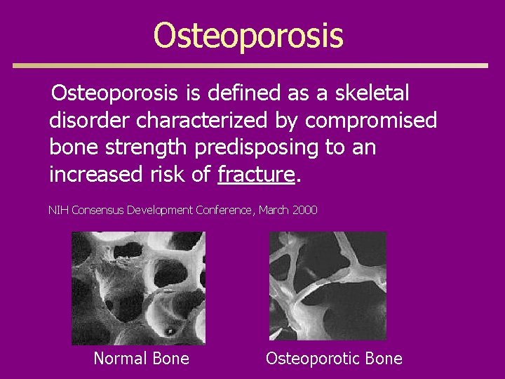 Osteoporosis is defined as a skeletal disorder characterized by compromised bone strength predisposing to